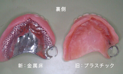 プラスチック床の入れ歯とコバルト床の入れ歯の比較