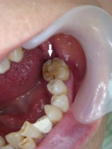 噛む を 固い が 痛い もの と 歯