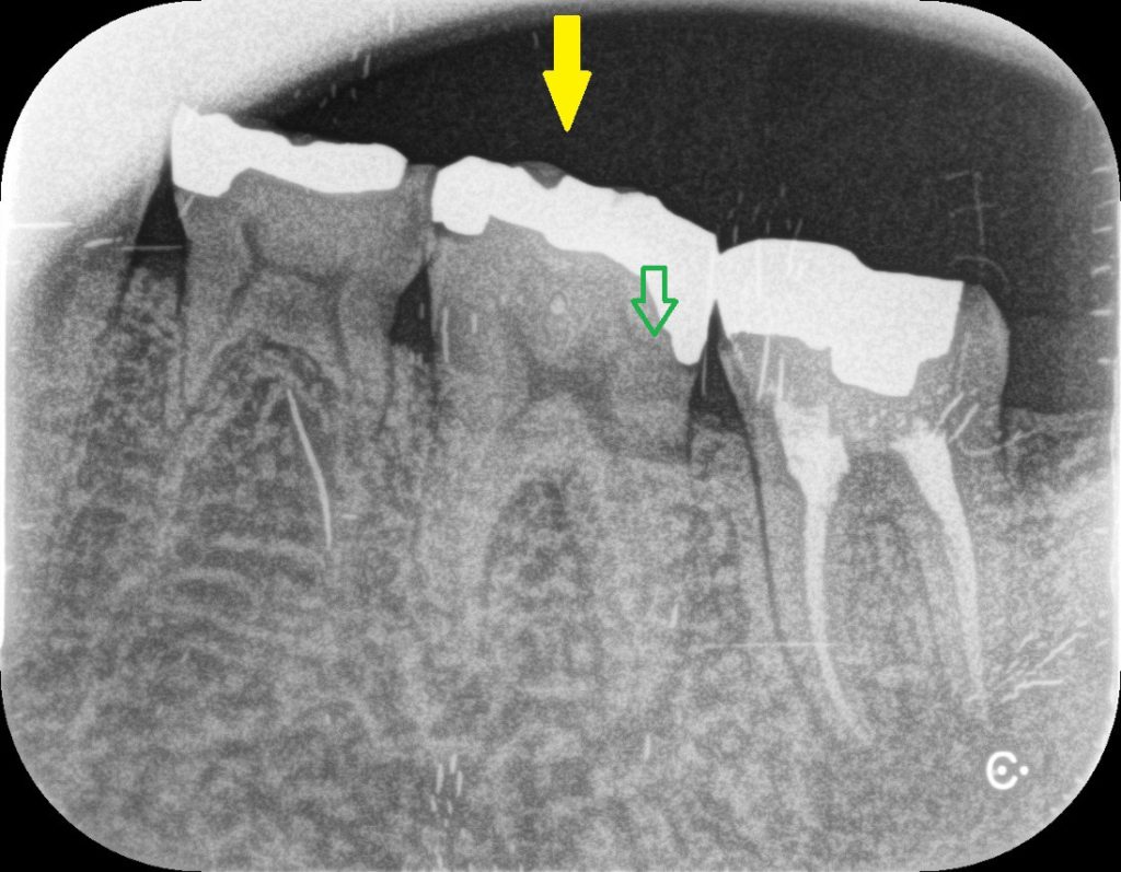 歯髄壊疽