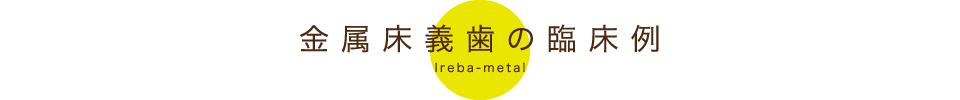 金属床入れ歯の臨床例