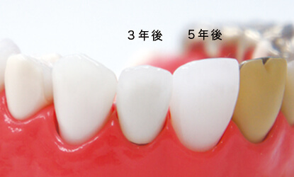 前歯セラミック素材