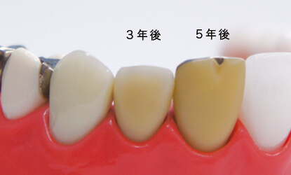 前歯プラスチックの経年