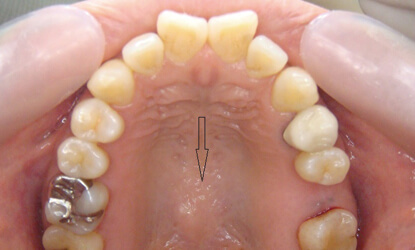 歯ぎしりをする人の口の中の状態
