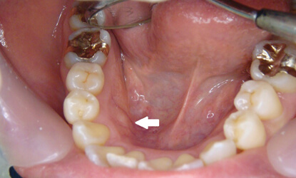 歯ぎしり対策はナイトガード・スプリント義歯