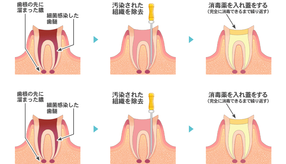 感染根管治療の流れ