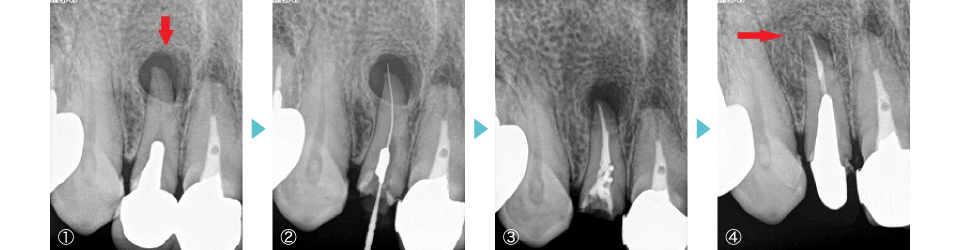 感染根管処置