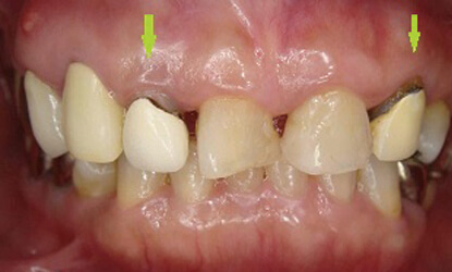 前歯の金銀パラジウム合金