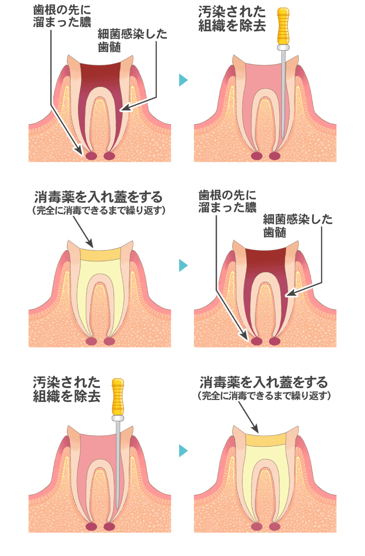 感染根管治療の流れ