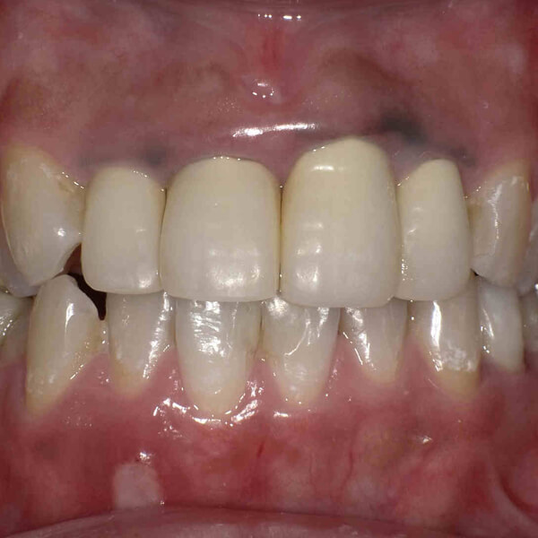 歯茎の黒ずみ除去