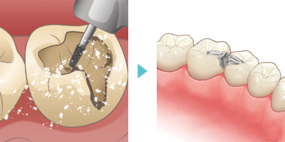 カリエスC1、C2の治療