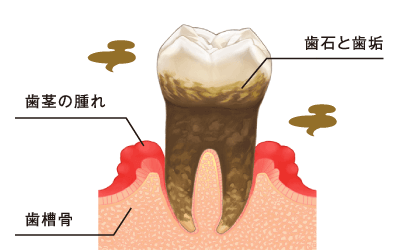 歯周病とは