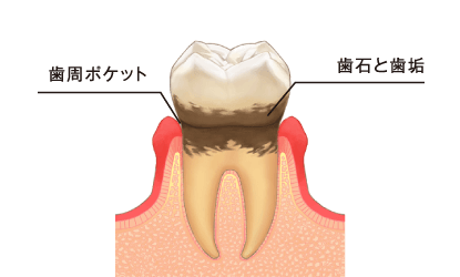 歯周病の原因