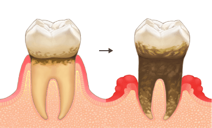 歯周病悪化