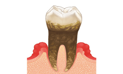 歯周病による歯茎の黒ずみ