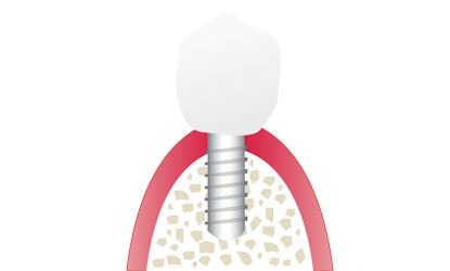 しっかり噛めるインプラント