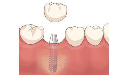 土台の歯が不要なインプラント