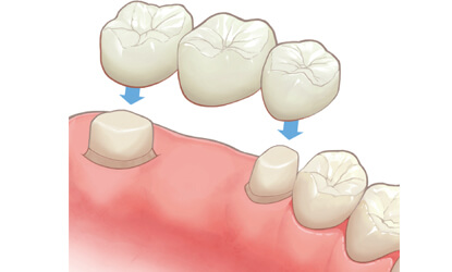健康の歯を削り土台にするブリッジ