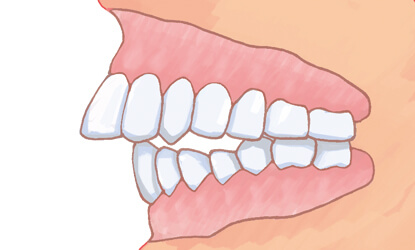 上顎前突の写真