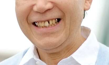 キラリとひかる銀歯は目立ちます