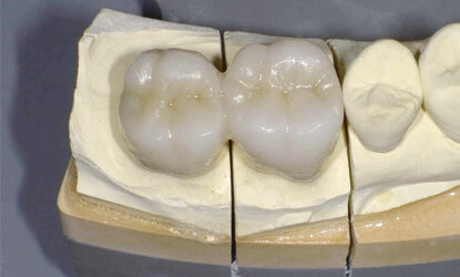 ジルコニアの補綴物