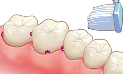 歯磨きだけでは落とせない汚れ