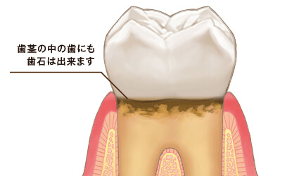 歯石になるまで