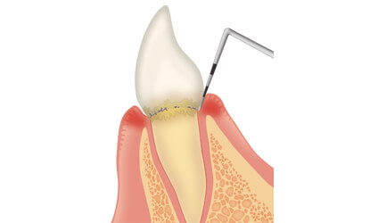 歯周ポケット検査