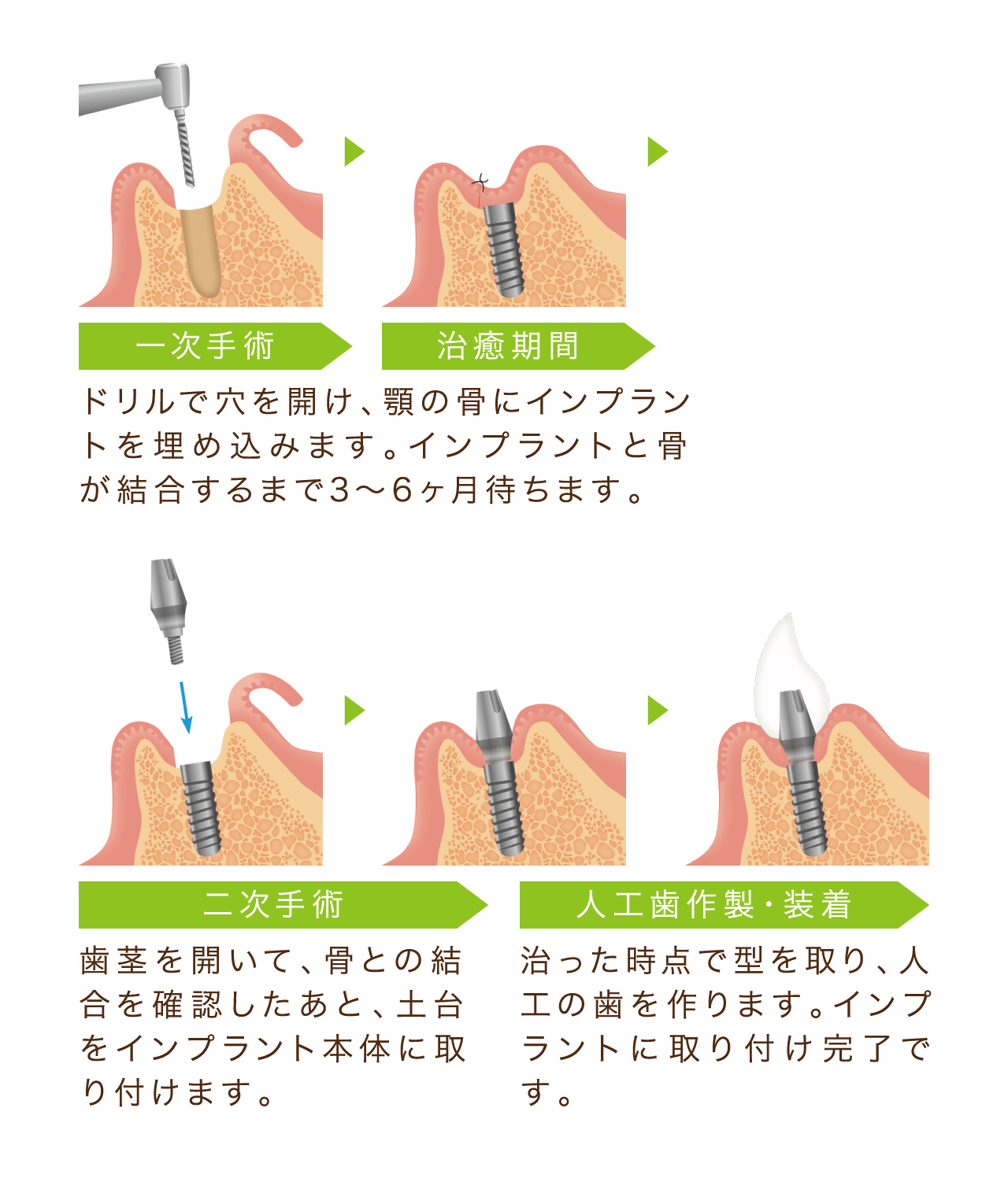 インプラントの手順